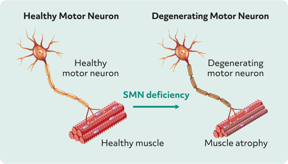 SMA Pathology